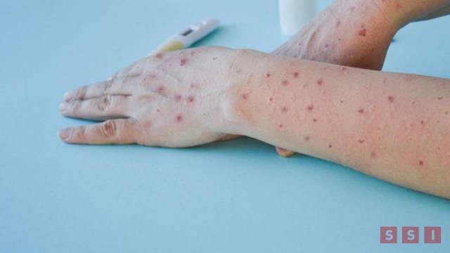 Susana Solis Informa ALERTAN por casos de viruela del mono en el sureste del país