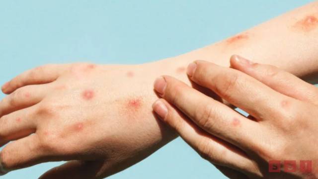 Susana Solis Informa Chiapas ocupa el décimo lugar con más casos de viruela símica