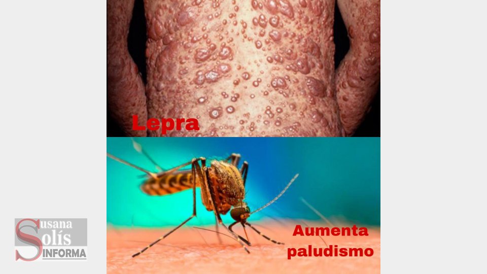 REPORTAN casos de lepra en Chiapas y aumento de paludismo Susana Solis Informa