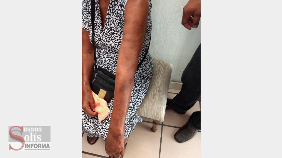 CONFIRMA secretaría de Salud en Chiapas casos de lepra Susana Solis Informa