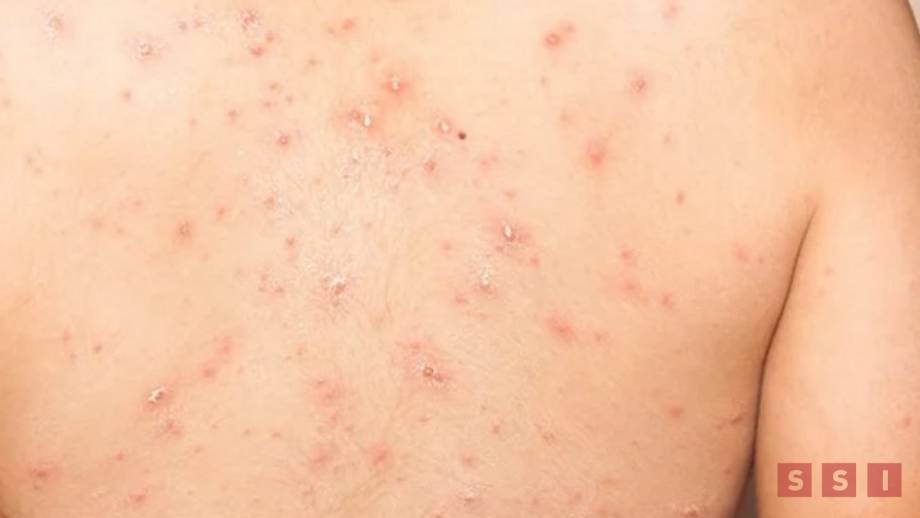 Nuevo caso de viruela símica en Chiapas Susana Solis Informa