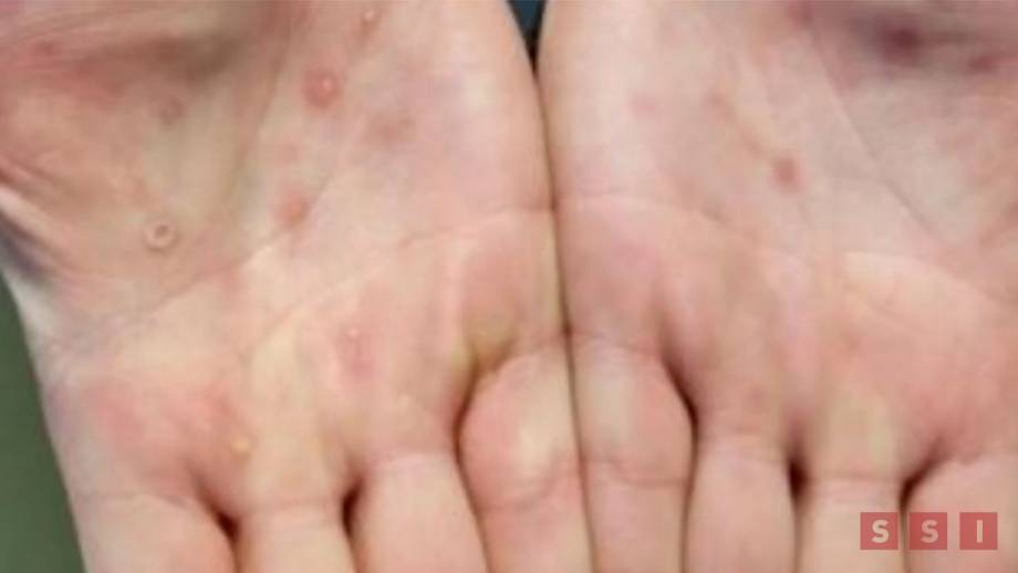 Acumula Chiapas 14 casos de viruela símica Susana Solis Informa