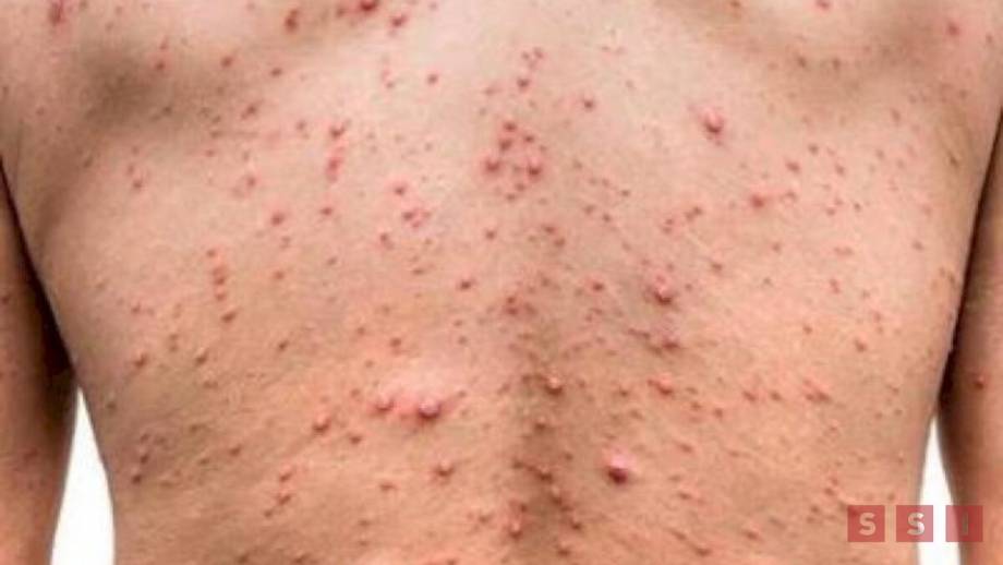 Chiapas llega a los 20 casos de viruela símica Susana Solis Informa